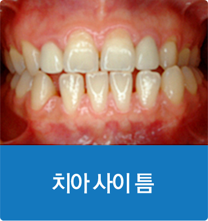치아 사이 틈